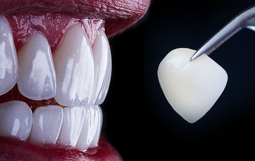 Veneers Kompo Ästhetische Zahnheilkunde Veeners für schöne Zähne