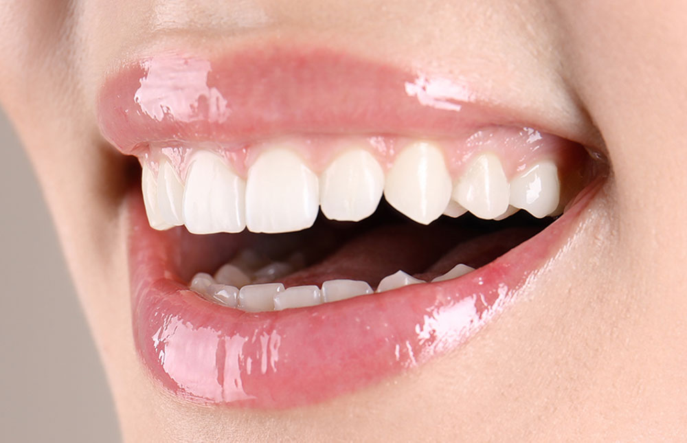 Ästhetische Zahnheilkunde Mund mit schönen weißen Zähnen nach dem Bleaching