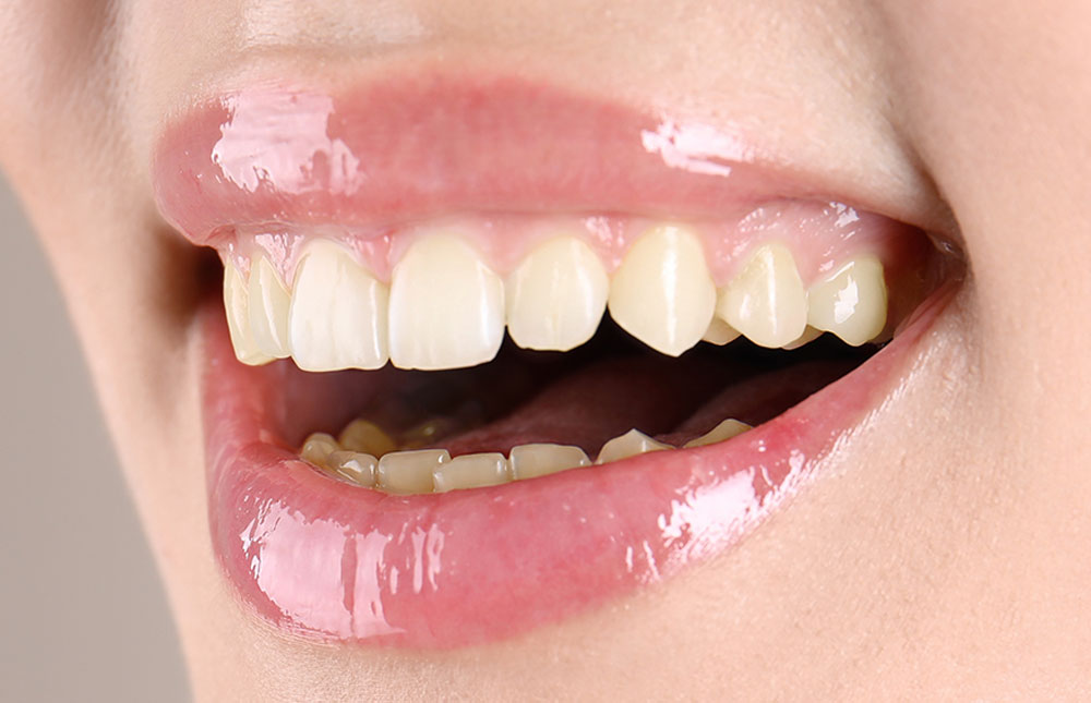 Ästhetische Zahnheilkunde Mund mit schönen Zähnen vor Bleaching