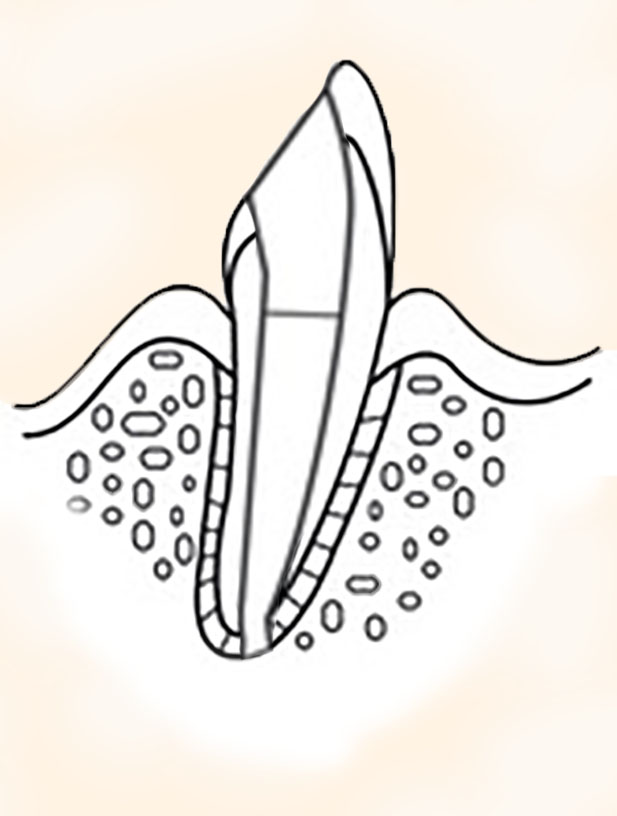 Aufgebauter Zahn Endodontie Wurzelbehandlung aufgebauter Zahn