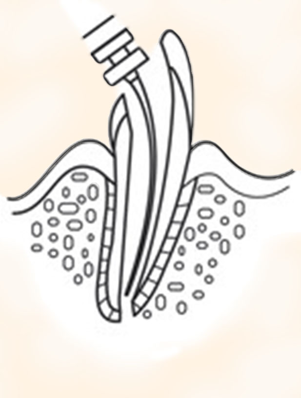 Zahnwurzel-Reinigung Endodontie Wurzelbehandlung