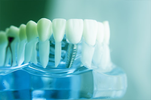 Einzel-Implantat-Stiftzahn Implantologie Einzel-Implantat-Stiftzahn