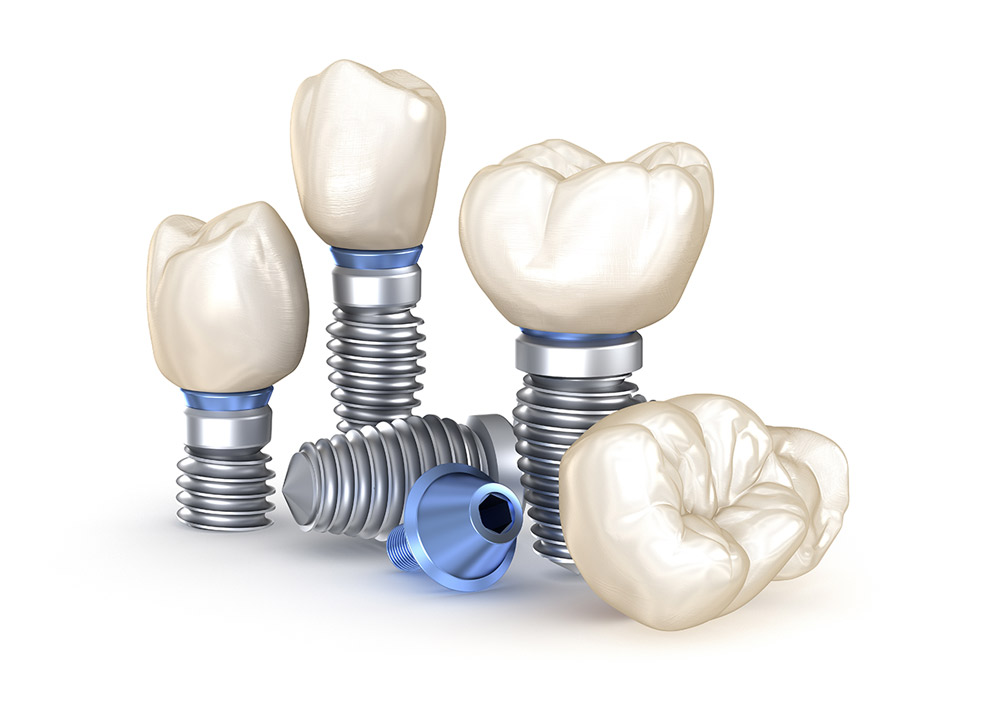 Implantat-Einzelteile Implantologie Implantat-Einzelteile