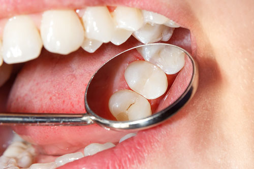 Endodontie Zahn-Wurzelkanalbehandlung