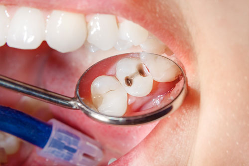 Endodontie Wurzelkanalbehandlung